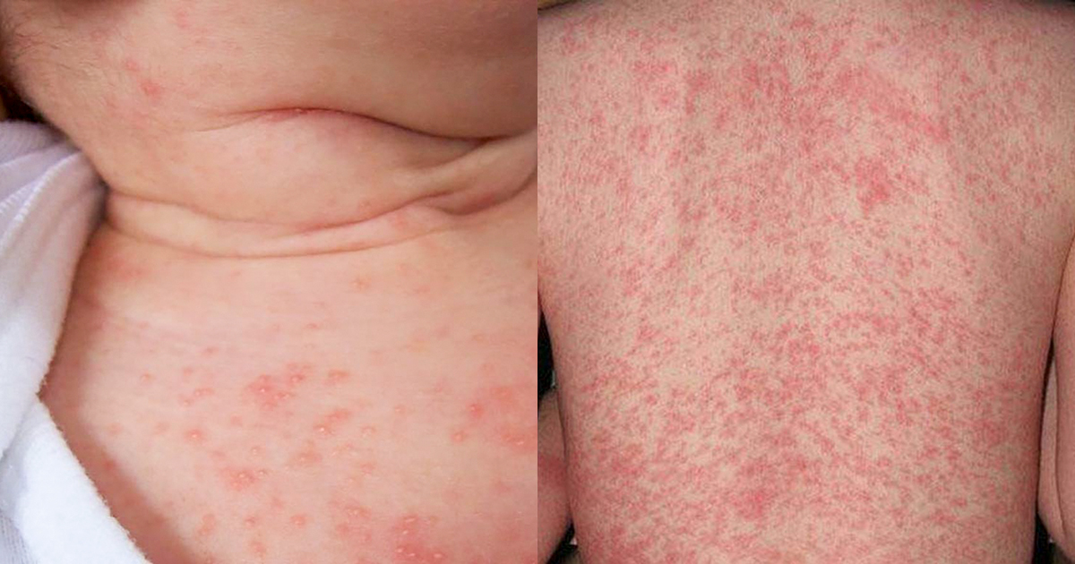 Mẩn đỏ, rôm sảy ở trẻ có nguy hiểm không? Cách xử lý an toàn tại nhà mẹ cần biết